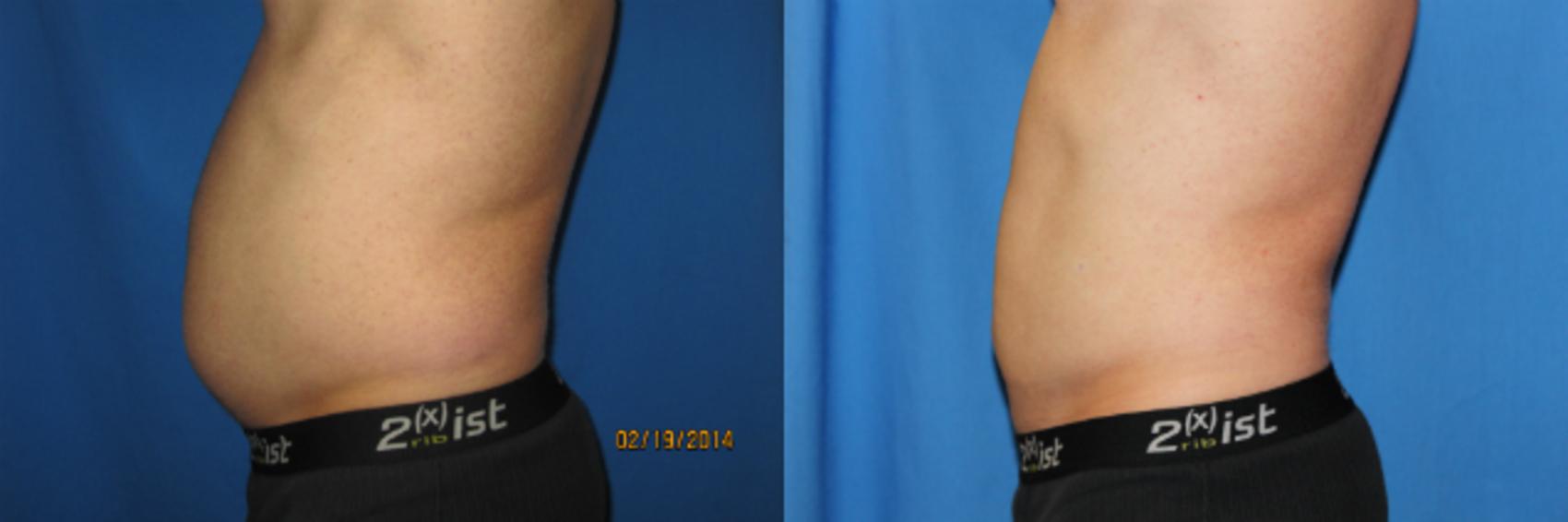 Before & After Liposuction - Abdomen / Flanks Case 61 View #3 View in Coeur d'Alene, ID