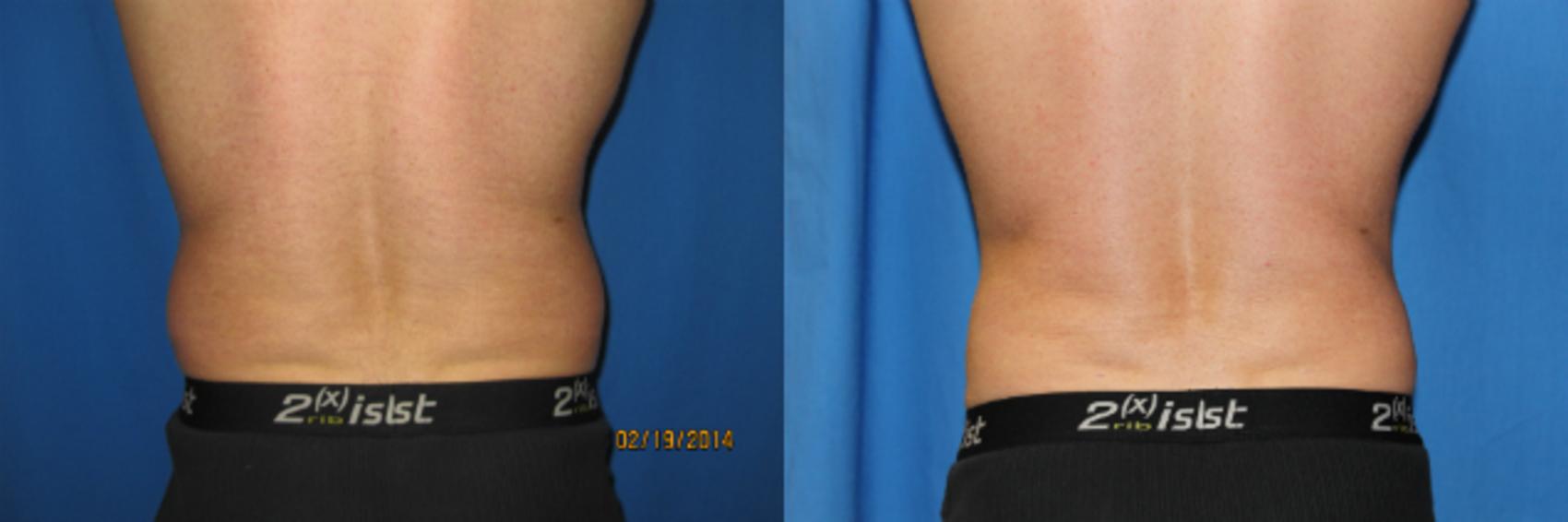 Before & After Liposuction - Abdomen / Flanks Case 61 View #4 View in Coeur d'Alene, ID