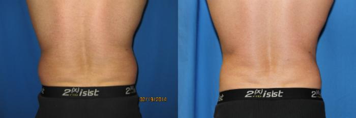 Before & After Liposuction - Abdomen / Flanks Case 61 View #4 View in Coeur d'Alene, ID