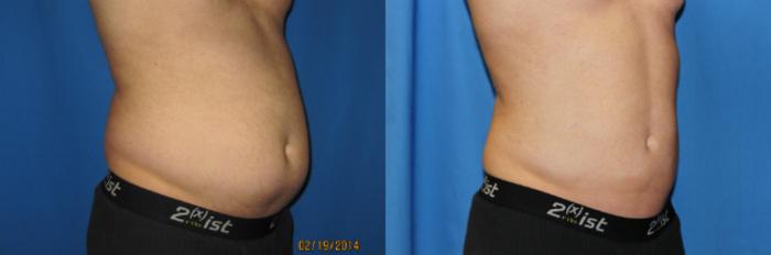 Before & After Liposuction - Abdomen / Flanks Case 61 View #5 View in Coeur d'Alene, ID