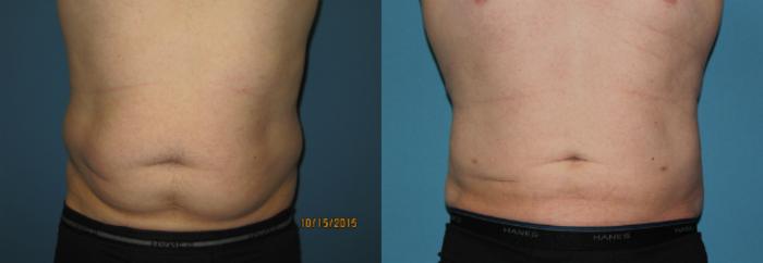 Before & After Liposuction - Abdomen / Flanks Case 62 View #1 View in Coeur d'Alene, ID