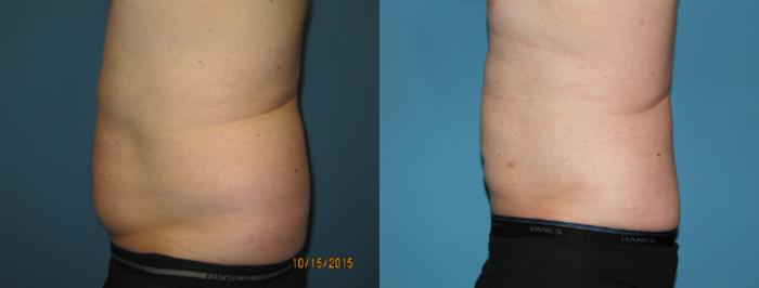 Before & After Liposuction - Abdomen / Flanks Case 62 View #2 View in Coeur d'Alene, ID