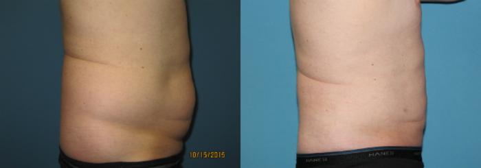 Before & After Liposuction - Abdomen / Flanks Case 62 View #3 View in Coeur d'Alene, ID