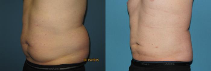 Before & After Liposuction - Abdomen / Flanks Case 62 View #4 View in Coeur d'Alene, ID