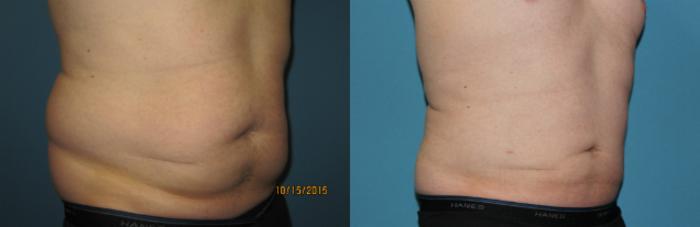 Before & After Liposuction - Abdomen / Flanks Case 62 View #5 View in Coeur d'Alene, ID