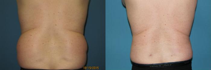 Before & After Liposuction - Abdomen / Flanks Case 62 View #6 View in Coeur d'Alene, ID