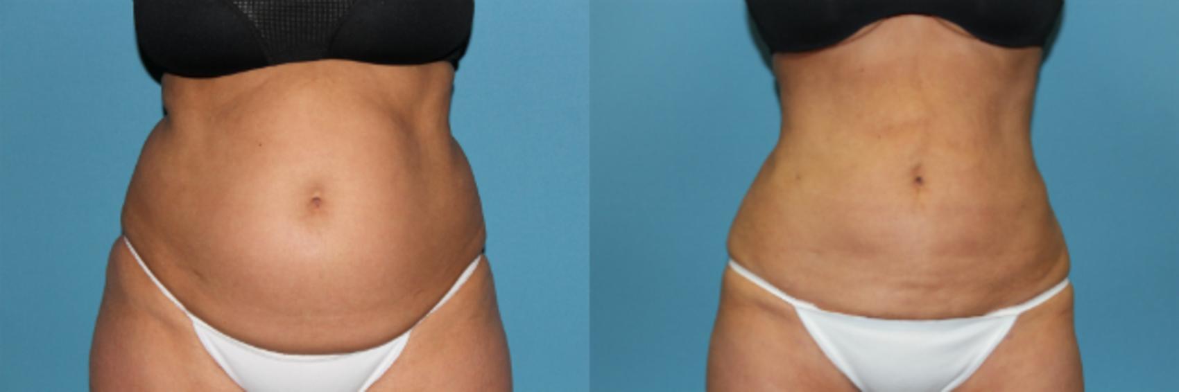 Before & After Liposuction - Abdomen / Flanks Case 63 View #1 View in Coeur d'Alene, ID