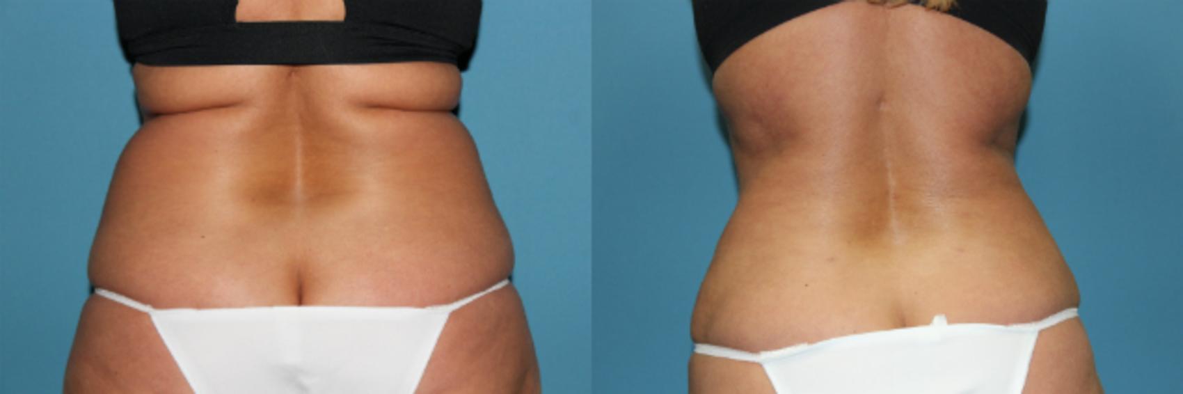 Before & After Liposuction - Abdomen / Flanks Case 63 View #2 View in Coeur d'Alene, ID
