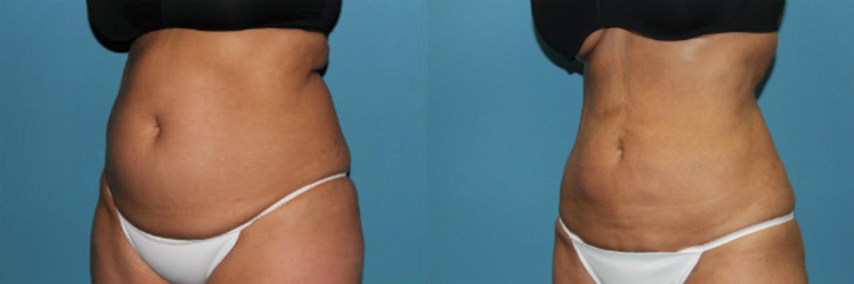 Before & After Liposuction - Abdomen / Flanks Case 63 View #3 View in Coeur d'Alene, ID
