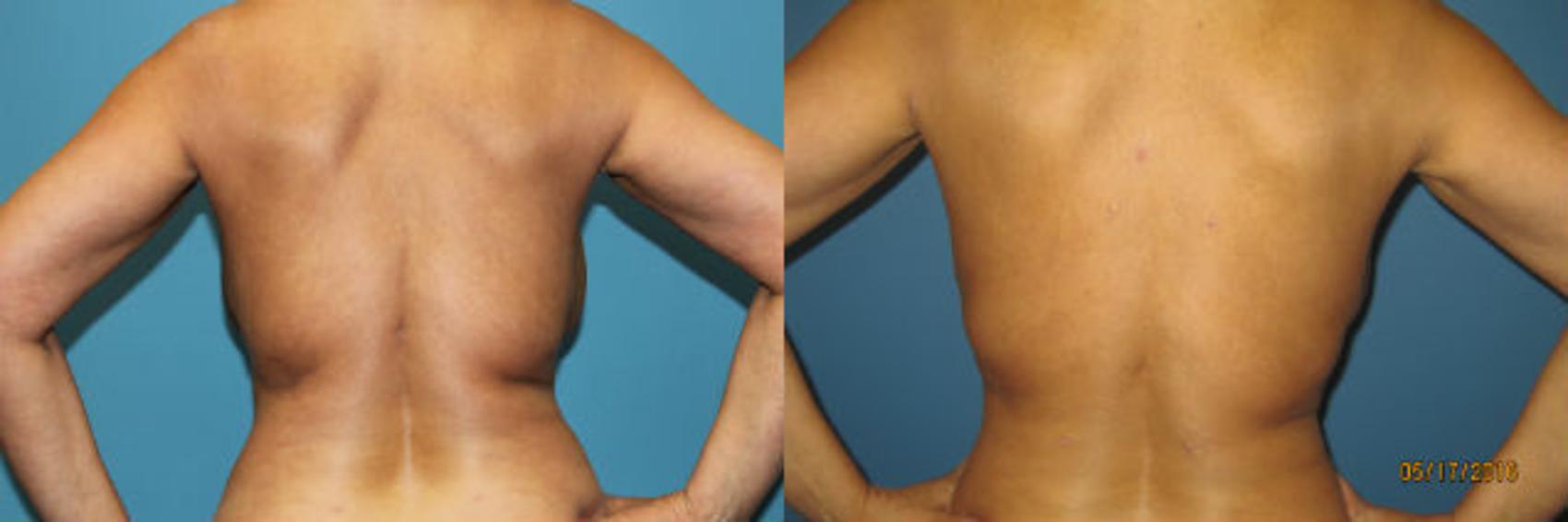 Before & After Liposuction - Abdomen / Flanks Case 63 View #4 View in Coeur d'Alene, ID