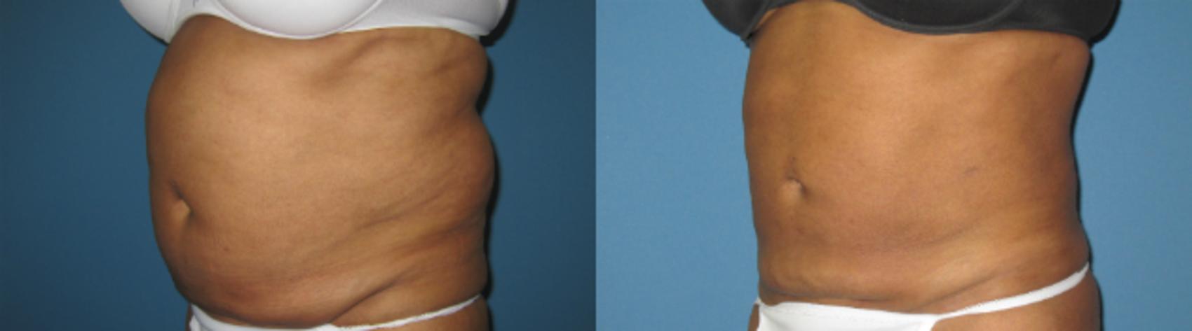 Before & After Liposuction - Abdomen / Flanks Case 70 View #1 View in Coeur d'Alene, ID