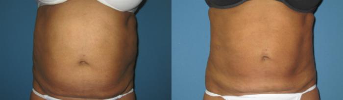 Before & After Liposuction - Abdomen / Flanks Case 70 View #2 View in Coeur d'Alene, ID