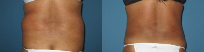 Before & After Liposuction - Abdomen / Flanks Case 70 View #3 View in Coeur d'Alene, ID