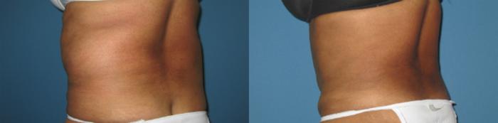 Before & After Liposuction - Abdomen / Flanks Case 70 View #4 View in Coeur d'Alene, ID