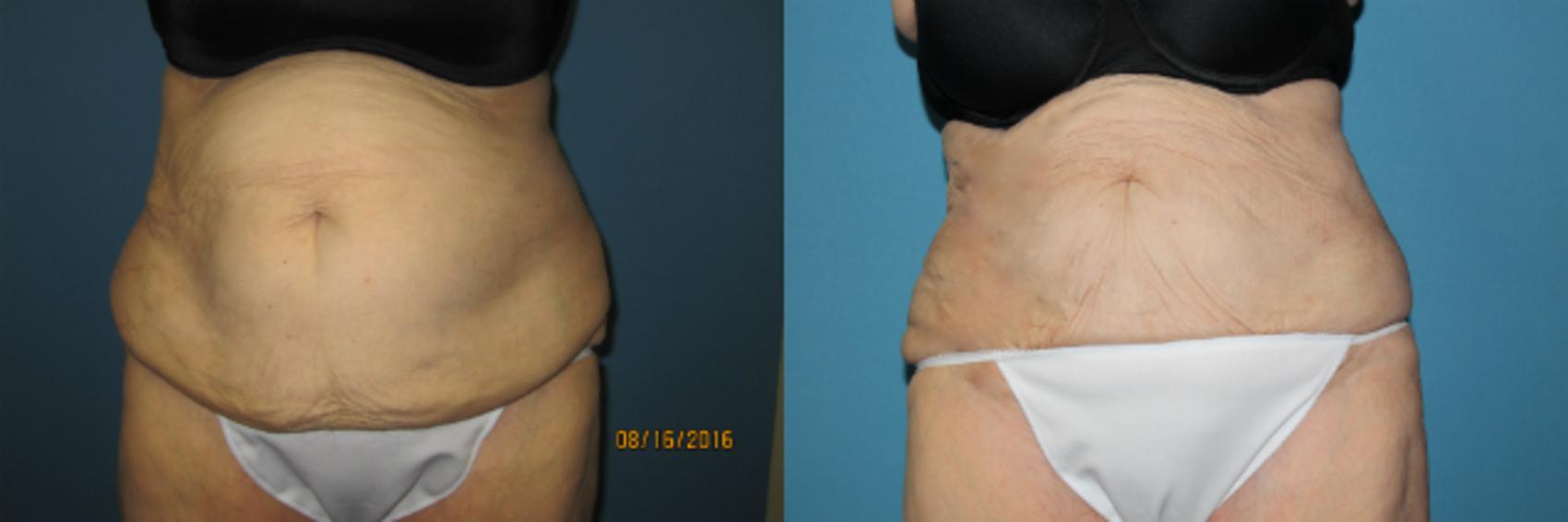 Before & After Liposuction - Abdomen / Flanks Case 71 View #1 View in Coeur d'Alene, ID