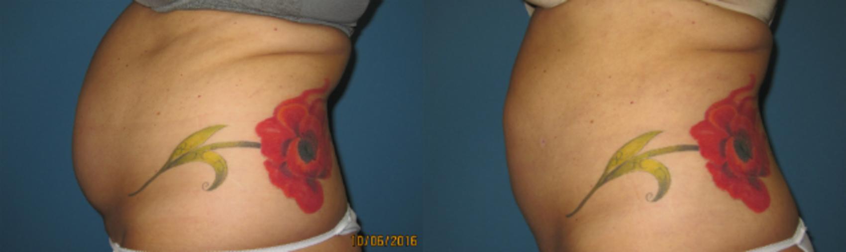 Before & After Liposuction - Abdomen / Flanks Case 78 View #1 View in Coeur d'Alene, ID