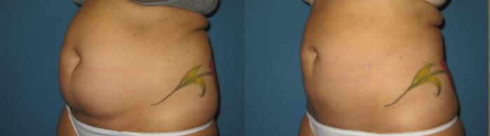Before & After Liposuction - Abdomen / Flanks Case 78 View #2 View in Coeur d'Alene, ID
