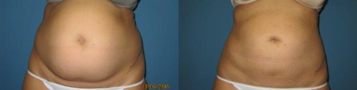 Before & After Liposuction - Abdomen / Flanks Case 78 View #3 View in Coeur d'Alene, ID