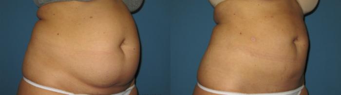 Before & After Liposuction - Abdomen / Flanks Case 78 View #4 View in Coeur d'Alene, ID
