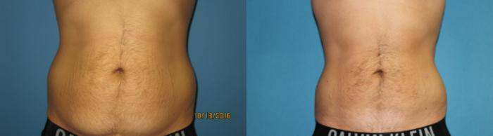 Before & After Liposuction - Abdomen / Flanks Case 79 View #1 View in Coeur d'Alene, ID