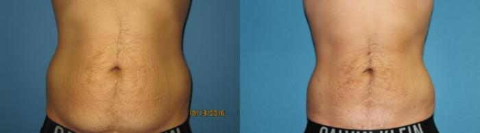 Liposuction of Flanks Before and After 3804