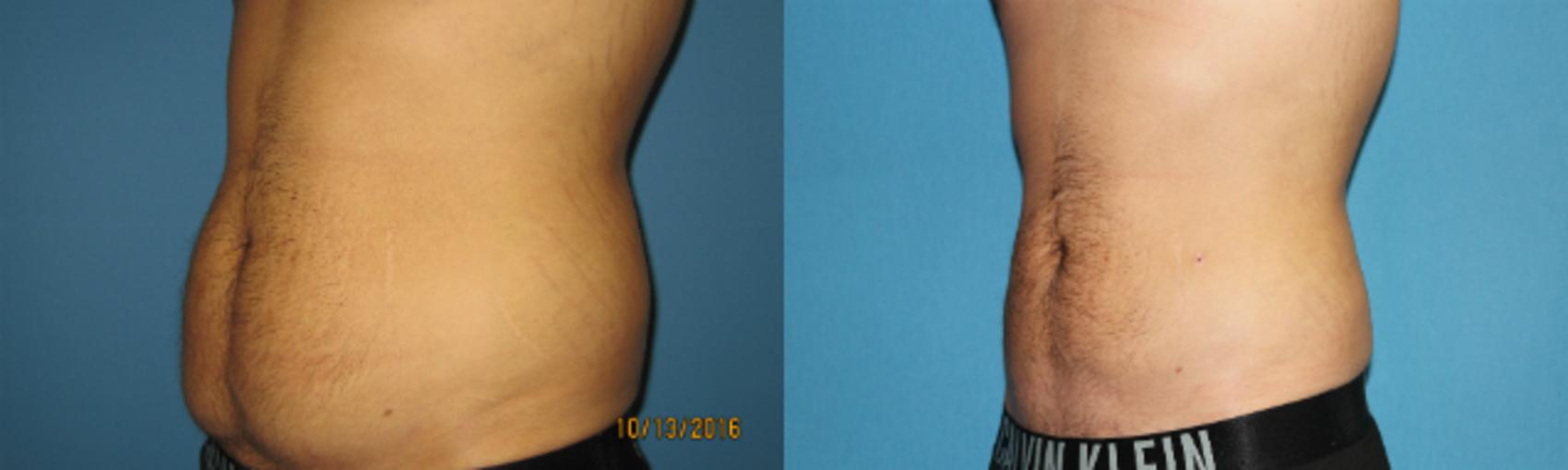 Before & After Liposuction - Abdomen / Flanks Case 79 View #2 View in Coeur d'Alene, ID