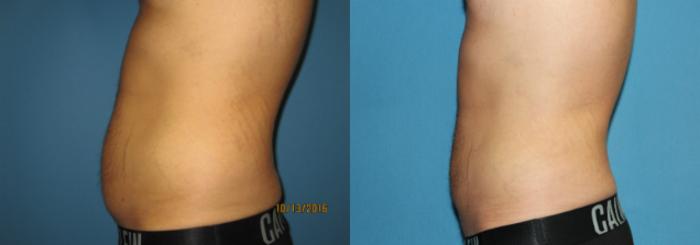 Before & After Liposuction - Abdomen / Flanks Case 79 View #3 View in Coeur d'Alene, ID