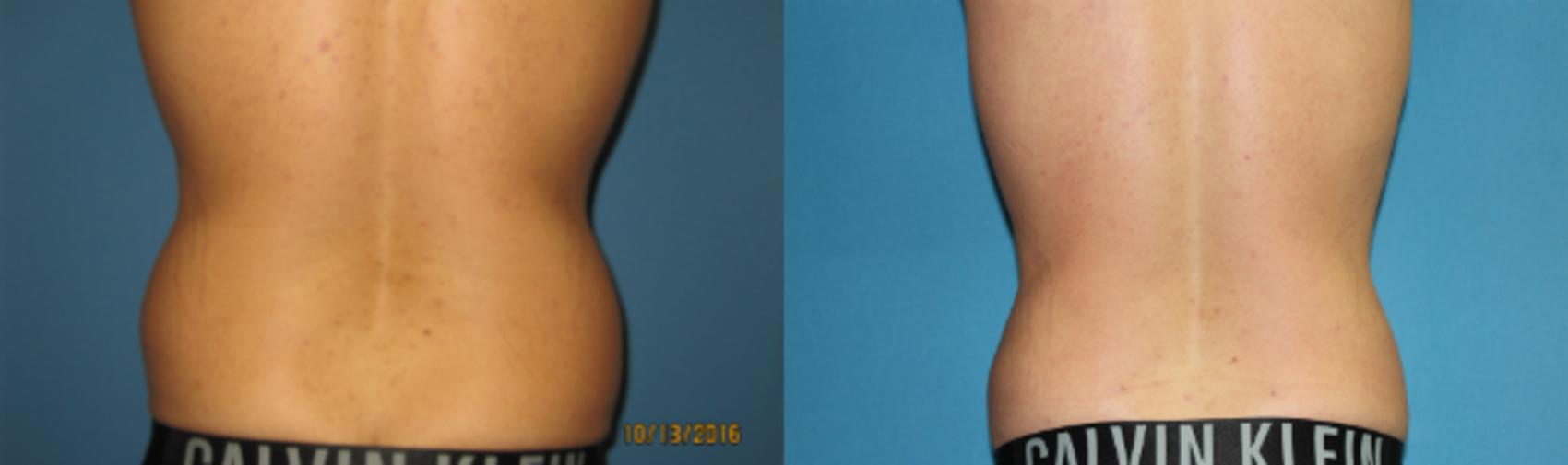 Before & After Liposuction - Abdomen / Flanks Case 79 View #4 View in Coeur d'Alene, ID