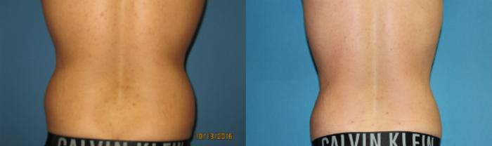 Before & After Liposuction - Abdomen / Flanks Case 79 View #4 View in Coeur d'Alene, ID