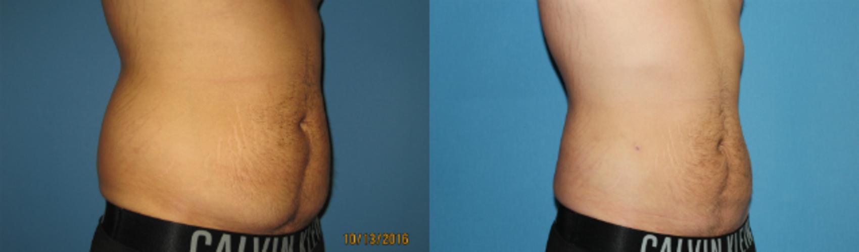 Before & After Liposuction - Abdomen / Flanks Case 79 View #5 View in Coeur d'Alene, ID