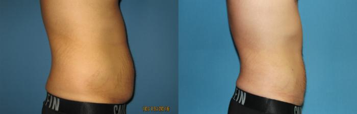 Before & After Liposuction - Abdomen / Flanks Case 79 View #6 View in Coeur d'Alene, ID