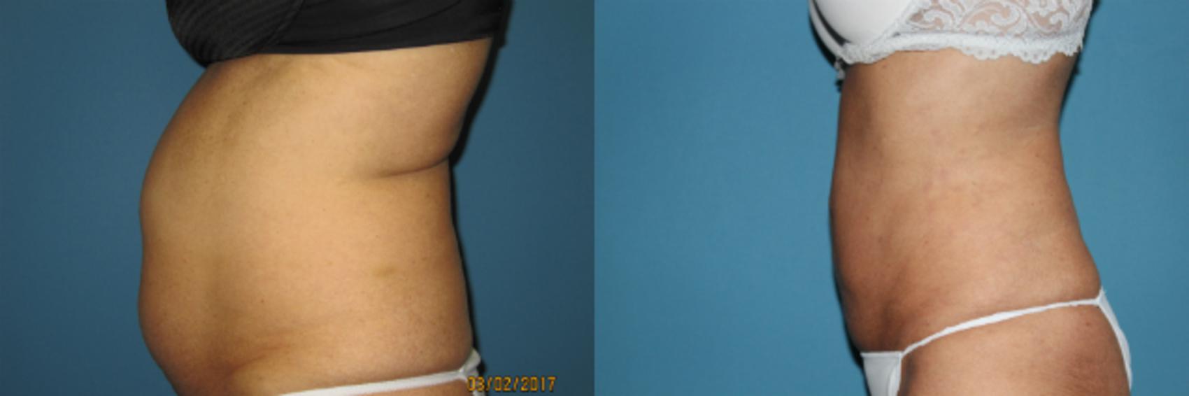 Before & After Liposuction - Abdomen / Flanks Case 85 View #1 View in Coeur d'Alene, ID
