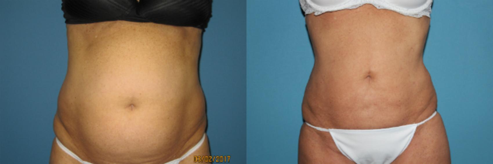 Before & After Liposuction - Abdomen / Flanks Case 85 View #2 View in Coeur d'Alene, ID