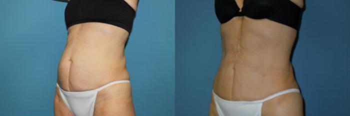 Before & After Liposuction - Abdomen / Flanks Case 89 View #1 View in Coeur d'Alene, ID