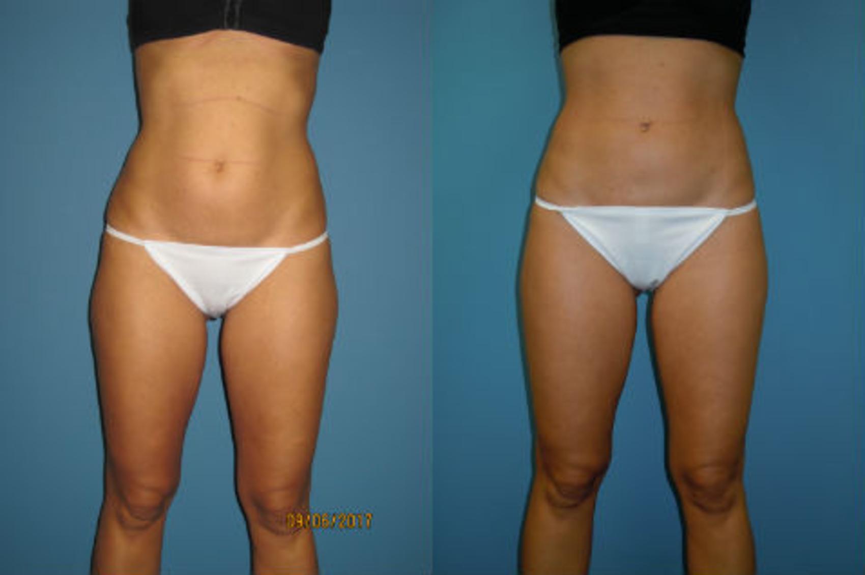 Before & After Liposuction - Inner and/or Outer Thighs Case 91 View #1 View in Coeur d'Alene, ID