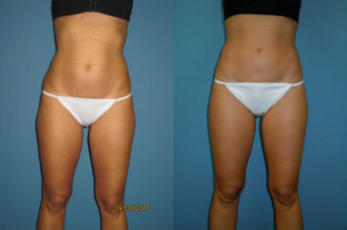 Before & After Liposuction - Abdomen / Flanks Case 91 View #1 View in Coeur d'Alene, ID
