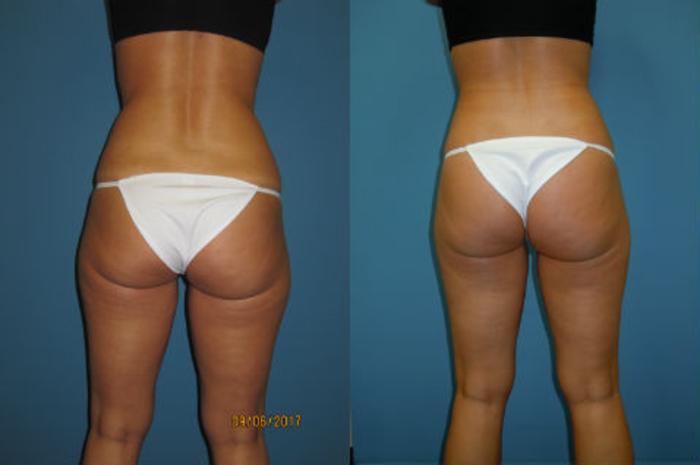 Before & After Liposuction - Abdomen / Flanks Case 91 View #2 View in Coeur d'Alene, ID