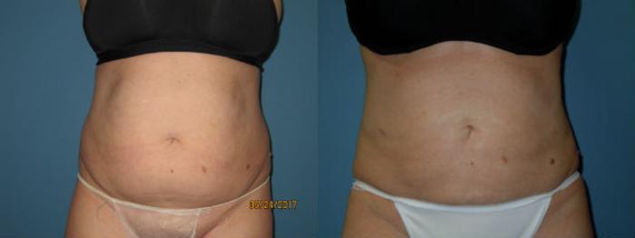 Before & After Liposuction - Abdomen / Flanks Case 92 View #1 View in Coeur d'Alene, ID