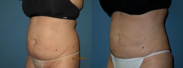 Before & After Liposuction - Abdomen / Flanks Case 92 View #2 View in Coeur d'Alene, ID