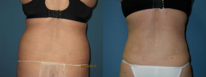 Before & After Liposuction - Abdomen / Flanks Case 92 View #3 View in Coeur d'Alene, ID