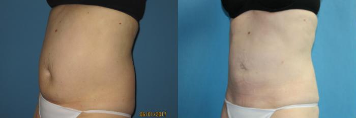 Before & After Liposuction - Abdomen / Flanks Case 93 View #1 View in Coeur d'Alene, ID