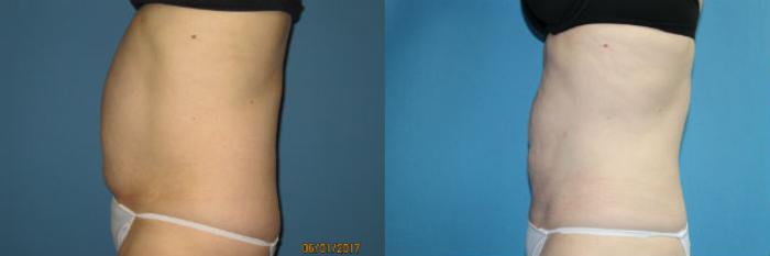 Before & After Liposuction - Abdomen / Flanks Case 93 View #2 View in Coeur d'Alene, ID