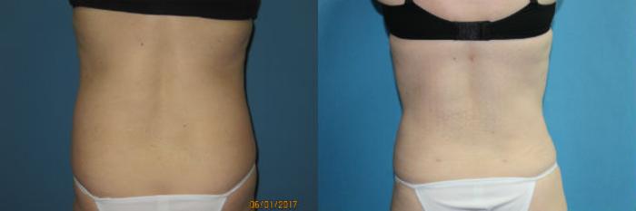 Before & After Liposuction - Abdomen / Flanks Case 93 View #3 View in Coeur d'Alene, ID