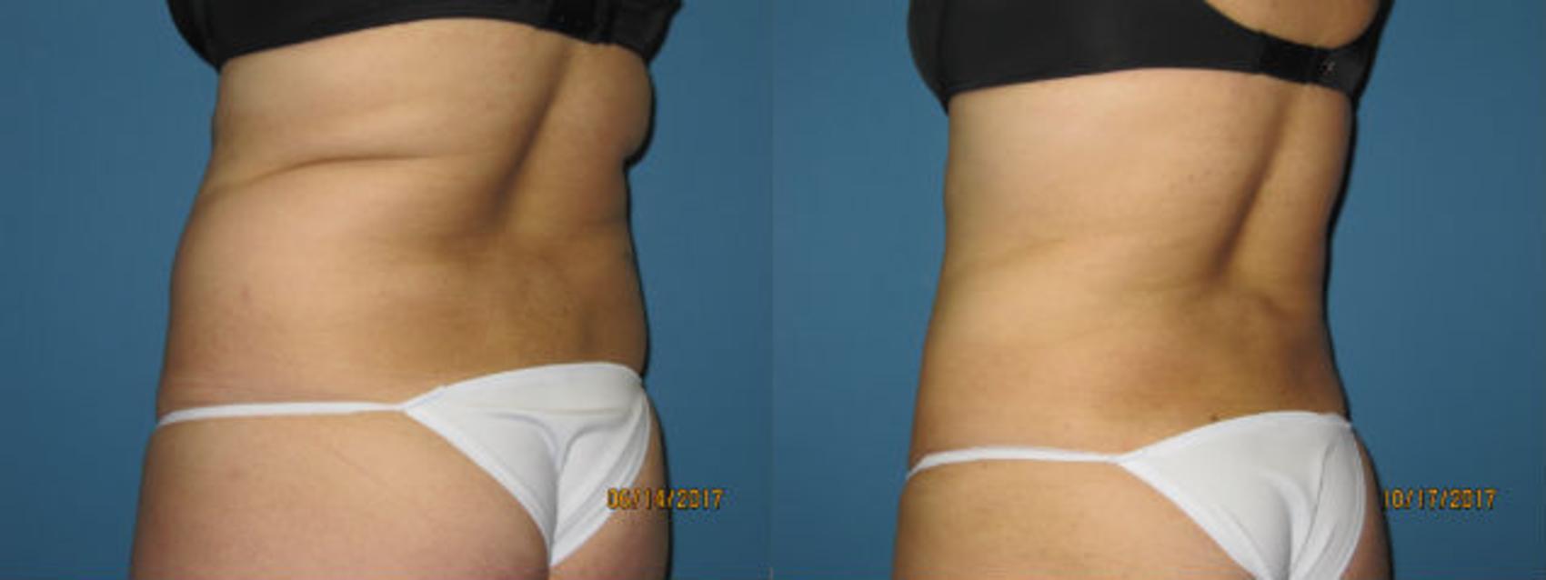 Before & After Liposuction - Abdomen / Flanks Case 94 View #1 View in Coeur d'Alene, ID