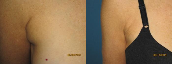 Armpit and Underarm Fat Removal