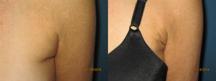 Before & After Liposuction - Arms / Axillary Case 143 View #2 View in Coeur d'Alene, ID