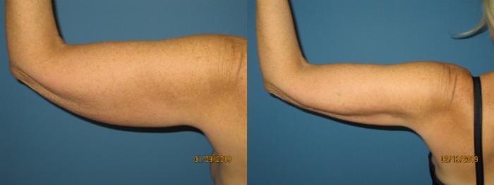 Before & After Liposuction - Arms / Axillary Case 143 View #3 View in Coeur d'Alene, ID