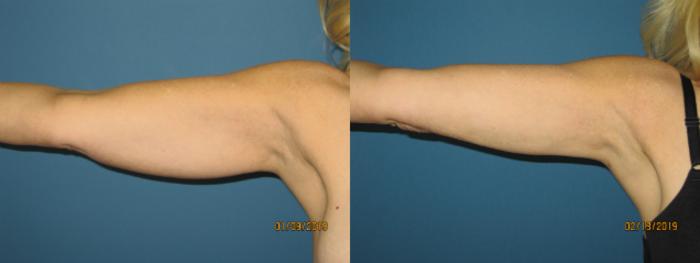 Before & After Liposuction - Arms / Axillary Case 143 View #4 View in Coeur d'Alene, ID