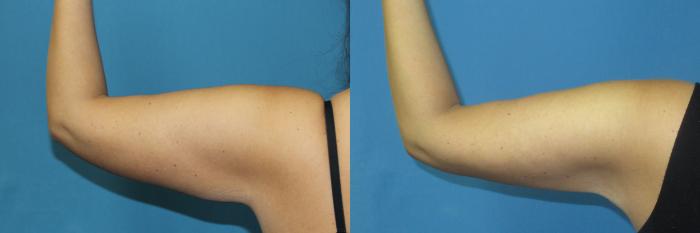Before & After Liposuction - Arms / Axillary Case 190 Left Back - Flexed View in Coeur d'Alene, ID