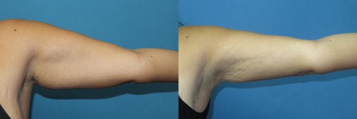 Before & After Liposuction - Arms / Axillary Case 190 Left Front - Straight out View in Coeur d'Alene, ID